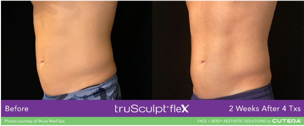 Non-Invasive Body Sculpting: A Safe and Effective Way to Reshape Your Body Non-Invasive Body Sculpting: A Safe and Effective Way to Reshape Your Body